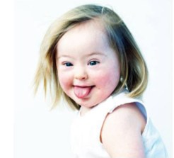 2-year old girl with Down syndrome taken from Weijerman, M., & de Winter, J. (2010). Clinical practice. The care of children with Down syndrome. European Journal Of Pediatrics, 169(12),